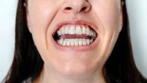 Invisalign Buttons vs Attachments