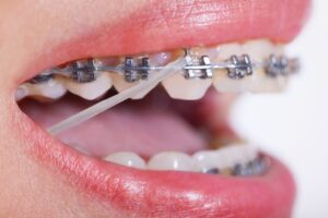 Braces Rubber Bands